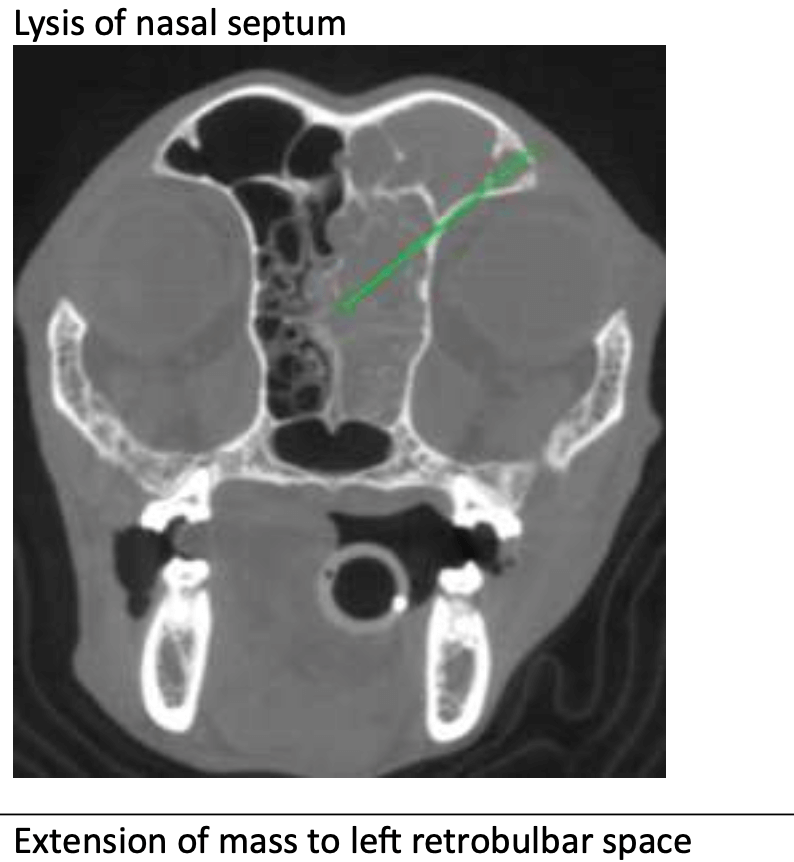 CT - Lysis of Nasal Septum