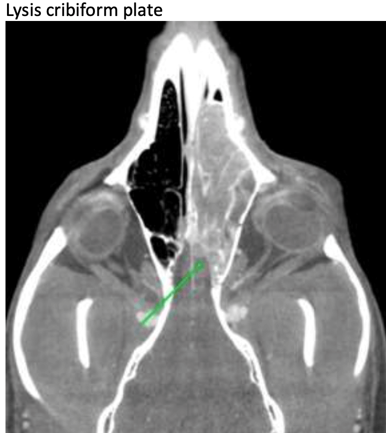 Lysis - Cribiform Plate